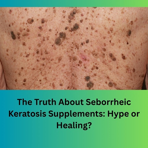 The Truth About Seborrheic Keratosis Supplements: Hype or Healing? - Natural Herbs Clinic Blog