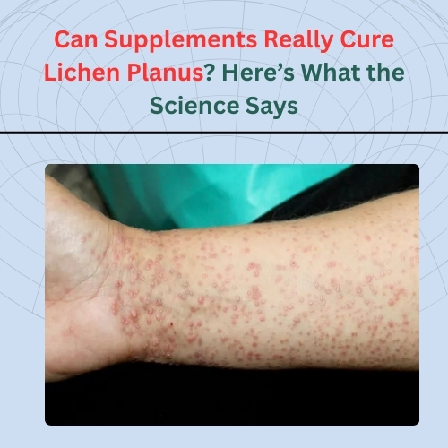 Can Supplements Really Cure Lichen Planus? Here’s What the Science Says - Herbs Solutions By Nature Blog