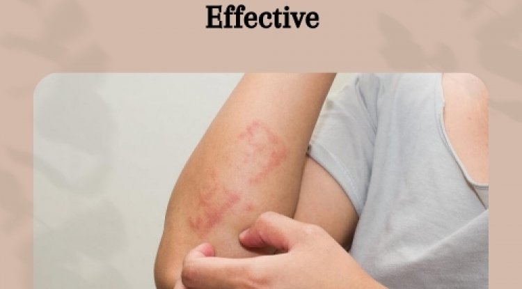 Doctor-Approved Supplements for Lichen Planus—Safe, Natural, and Effective - Dubai Entertainment