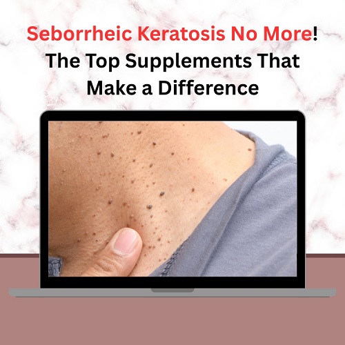 Seborrheic Keratosis No More! The Top Supplements That Make a Difference - Super Herbal Care