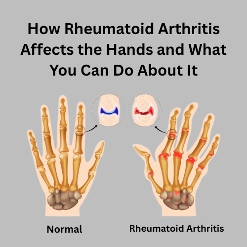 How Rheumatoid Arthritis Affects the Hands and What You Can Do About It - Herbal Care Products - Blog
